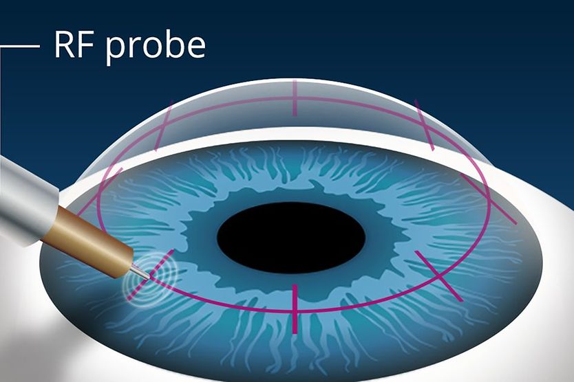 Conductive keratoplasty (CK) reduces need for reading glasses illustration of conductive keratoplasty (CK) procedure