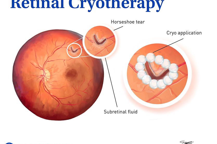 Cryopexy (retinal cryotherapy) Illustration of retinal cryotherapy procedure.