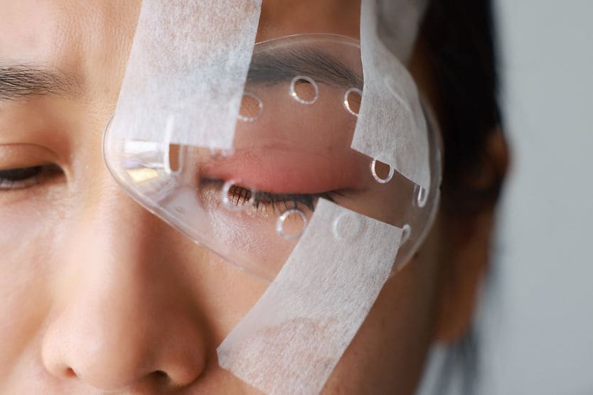 Detached retina recovery Eye shield used during recovery from detached retina surgery