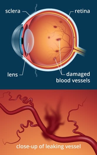 Laser photocoagulation eye surgery: Uses, benefits and what to expect Laser photocoagulation eye surgery: Uses, benefits and what to expect