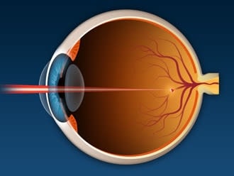 Laser photocoagulation eye surgery: Uses, benefits and what to expect Laser photocoagulation eye surgery: Uses, benefits and what to expect