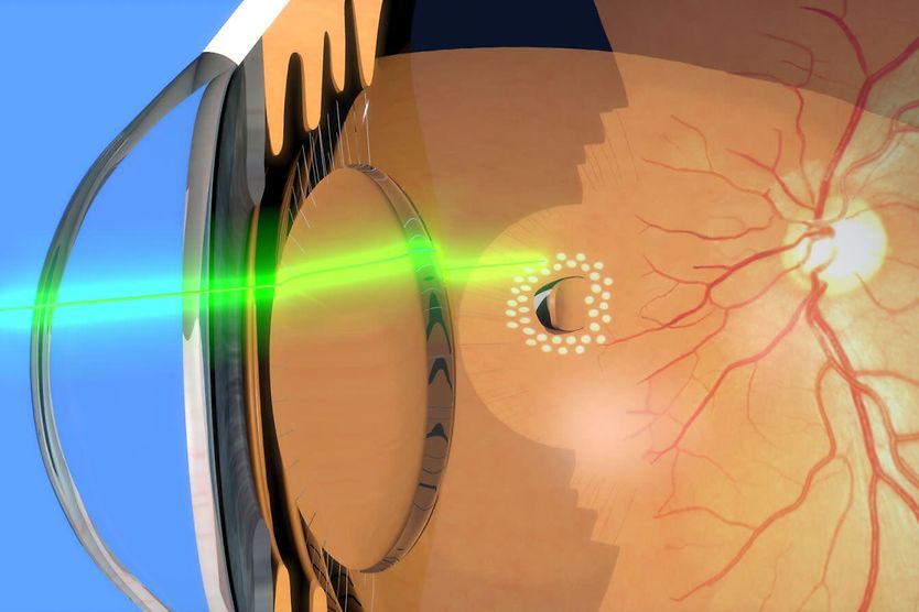 Laser photocoagulation eye surgery: Uses, benefits and what to expect Depiction of laser photocoagulation around retinal tear