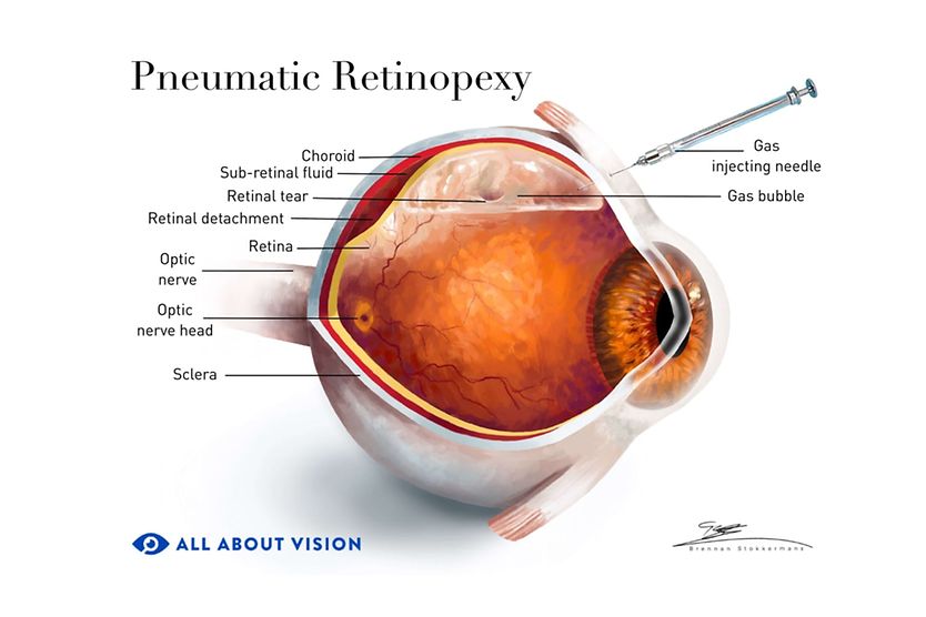Pneumatic retinopexy Image showcasing the anatomy of the eye, and what a detached retina looks like before pneumatic retinopexy surgery.