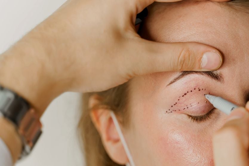Ptosis surgery for droopy eyelids