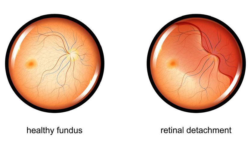 Retinal tear surgery Retinal tear v. a normal eye.