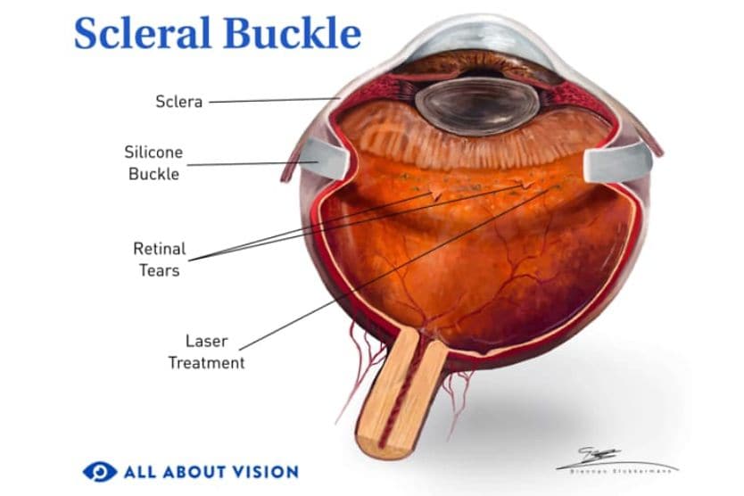 What is a scleral buckle? Illustration of elements that make up a scleral buckle
