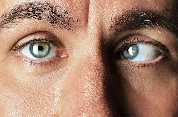 man with strabismus Young girl with strabismus