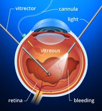 Vitrectomy And Vitreoretinal Eye Surgery
