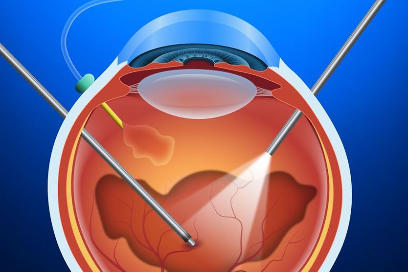 Vitrectomy And Vitreoretinal Eye Surgery vitrectomy illustration