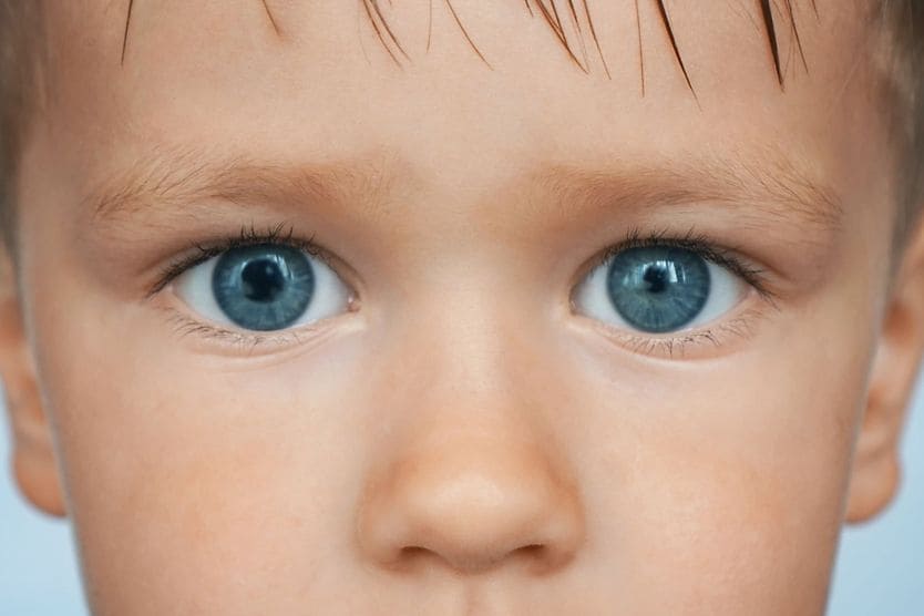 bambino con anisocoria bambino con anisocoria