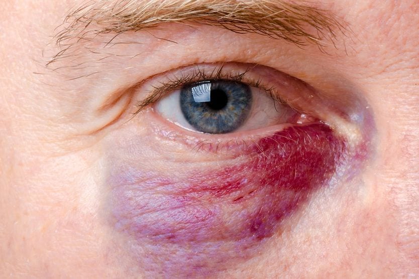 Uomo con occhio nero (ematoma periorbitale)