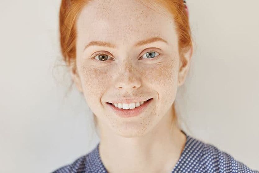 Heterochromia is having different-colored eyes Girl with heterochromia