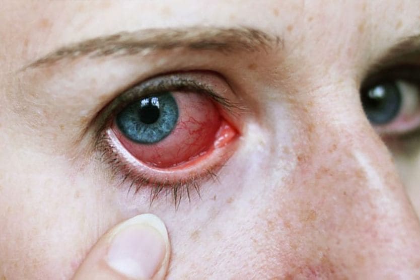 La ragazza tira giù la palpebra per mostrare l'occhio rosso e irritato
