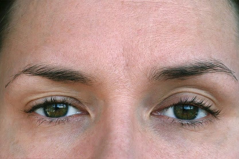 Donna con palpebre cadenti da ptosi Donna con palpebre cadenti da ptosi