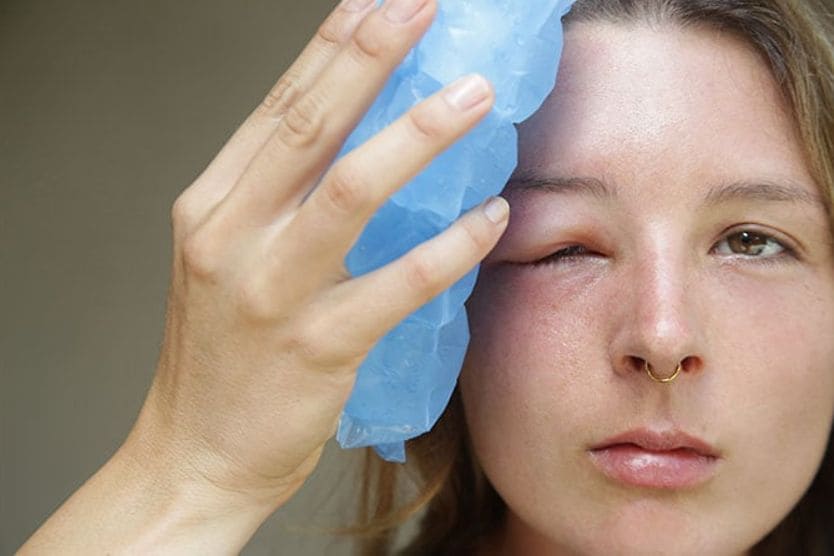 donna con una palpebra gonfia donna con una palpebra gonfia
