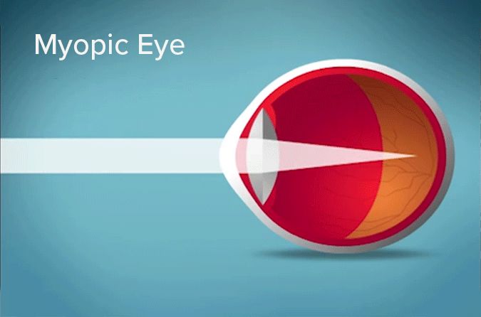 Is nearsightedness due to the eyeball being too long?