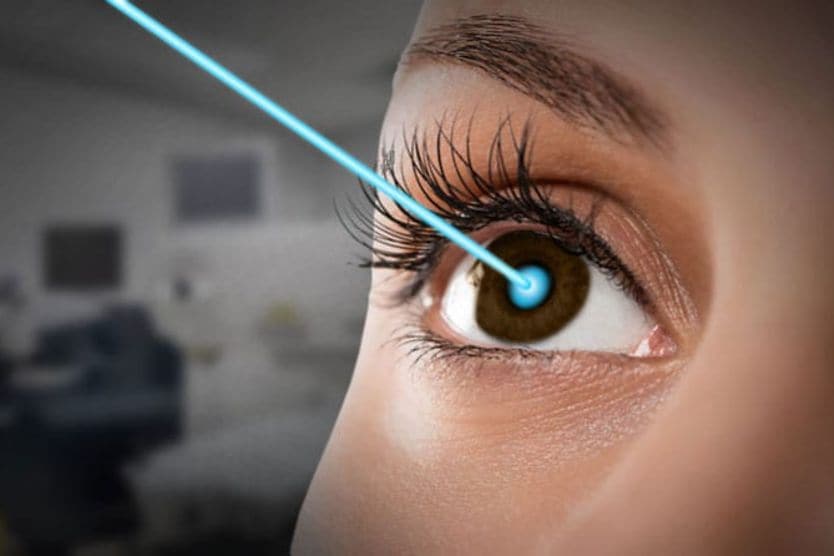 rappresentazione della chirurgia laser dell'occhio rappresentazione della chirurgia laser dell'occhio