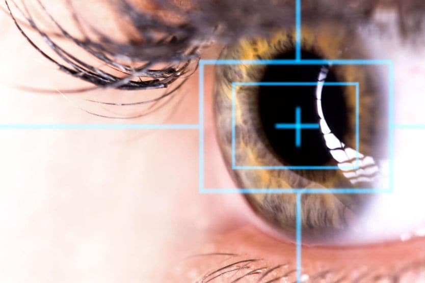 illustrazione dell'incisione della chirurgia oculare laser SMILE illustrazione dell'incisione della chirurgia oculare laser SMILE