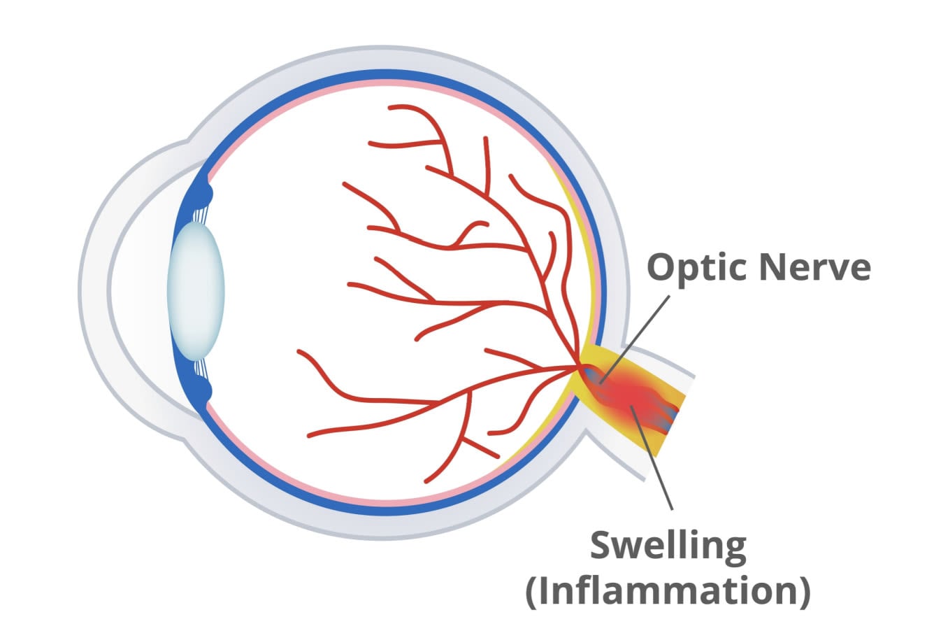 Diagram of Papilledema