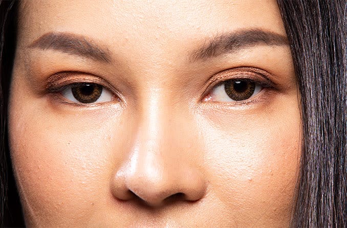 closeup of a woman with droopy eyelids (ptosis)