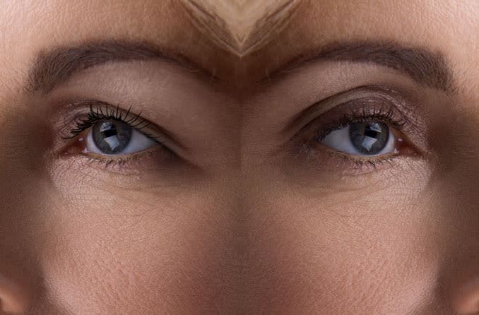 before and after side by side image of eyelid surgery