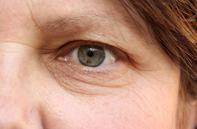 closeup of a woman with droopy eyelid (ptosis)