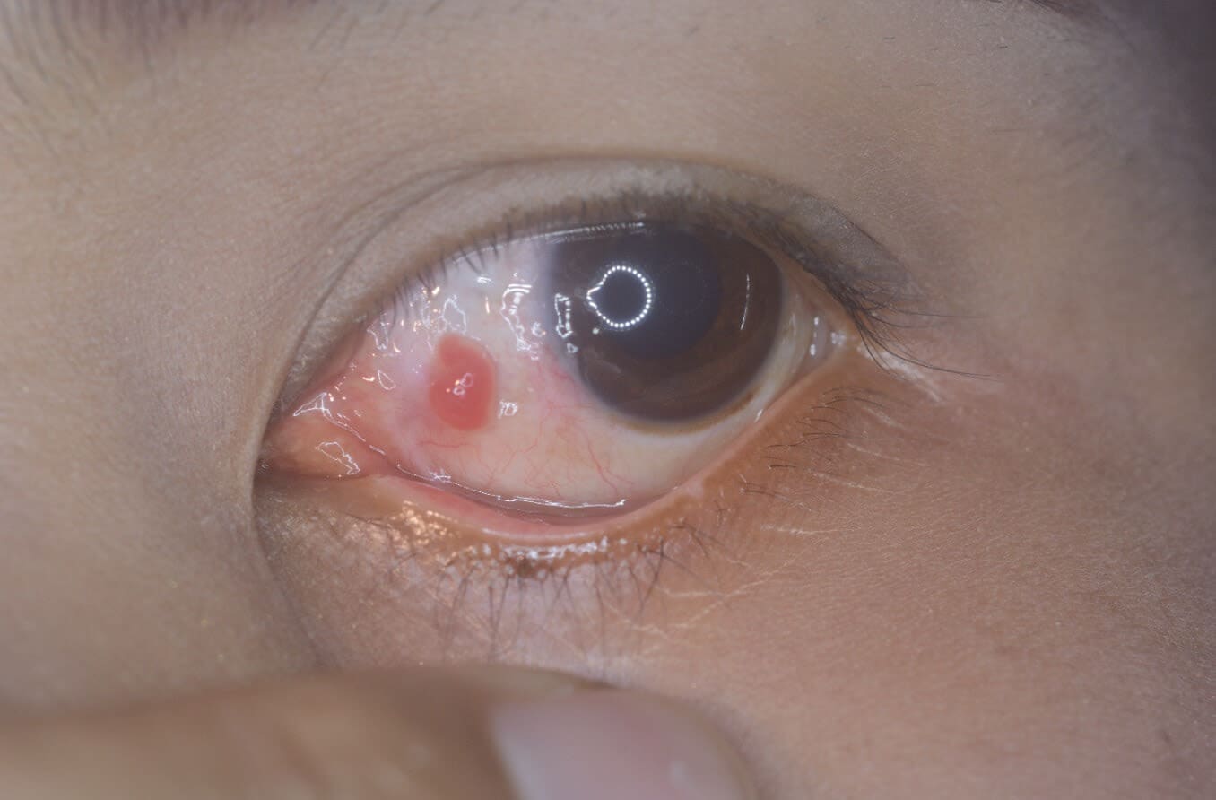 close up of eye pyogenic granuloma