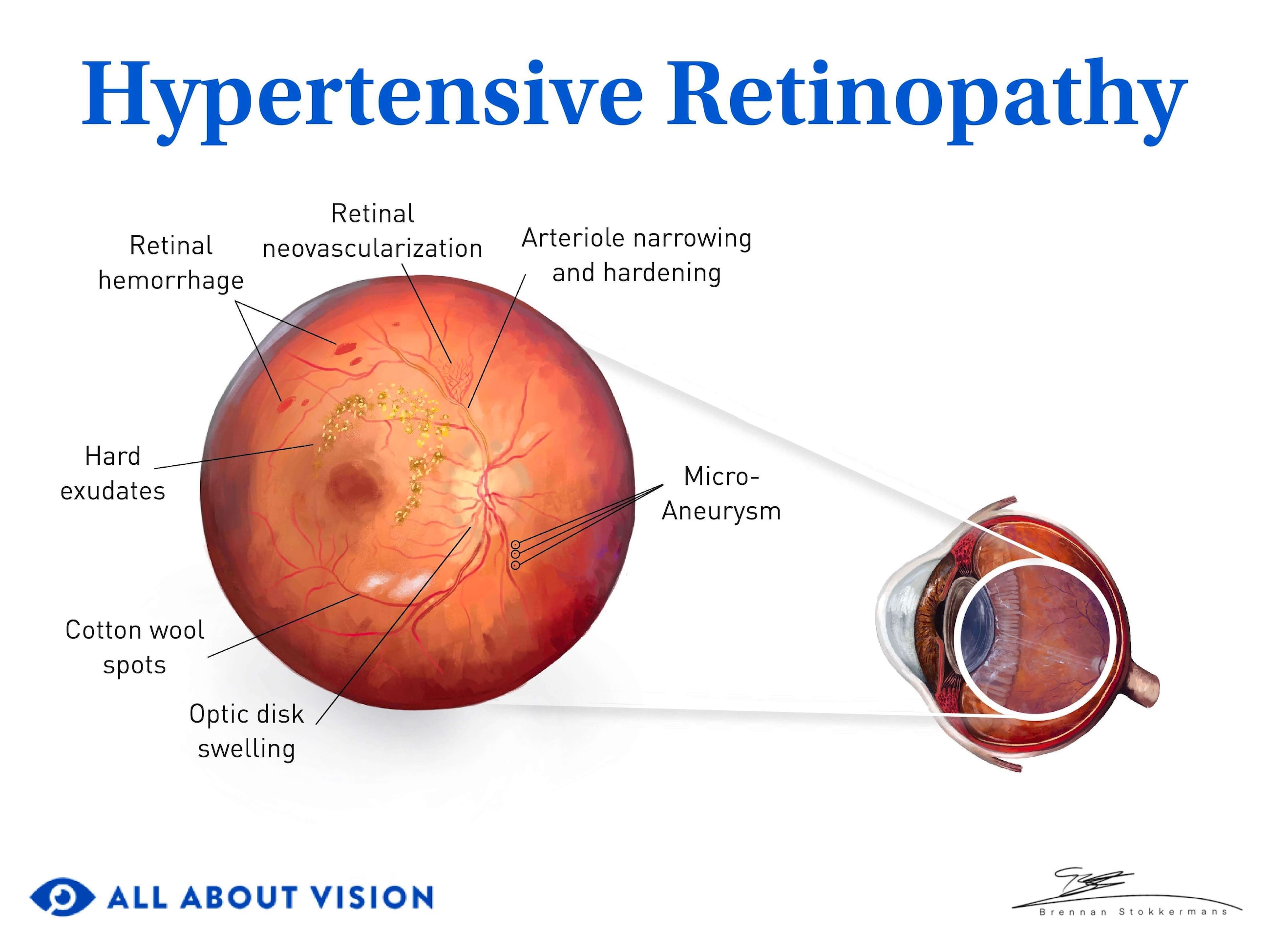 hypertensive retinopathy medical illustration.