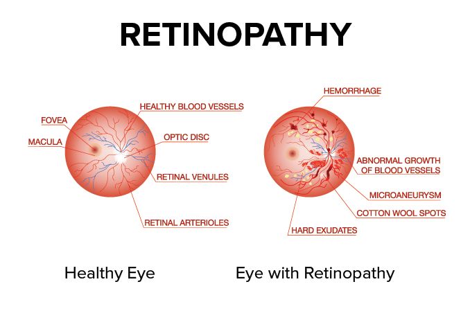 diagram illustrating the difference between and eye with retinopathy vs. a healthy eye