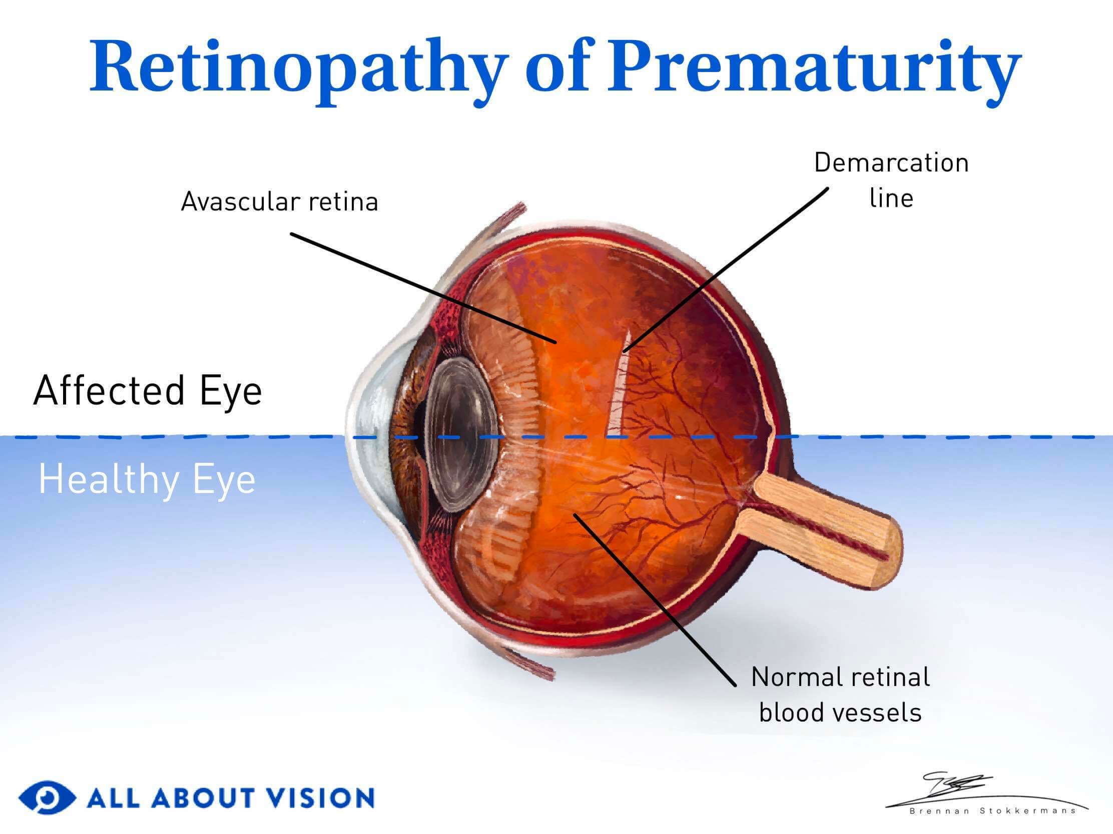 Normal eye v eye with retinopathy of prematurity.