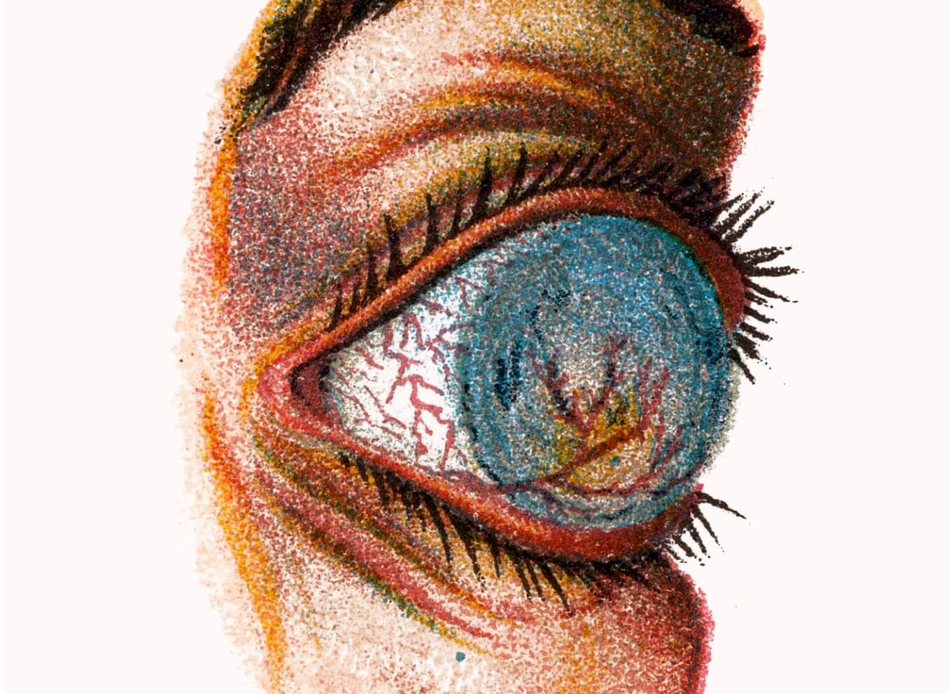 Illustration of the eye diseases Staphyloma