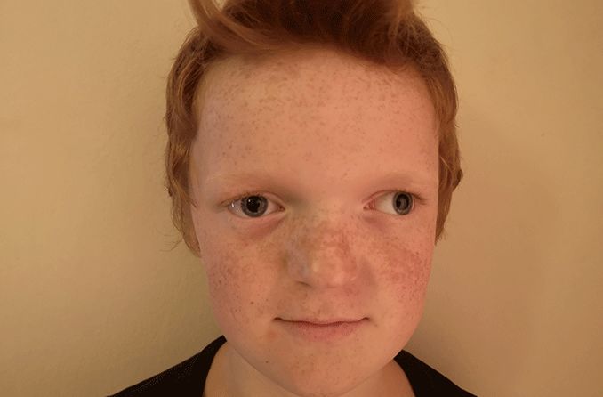 young boy with exotropia