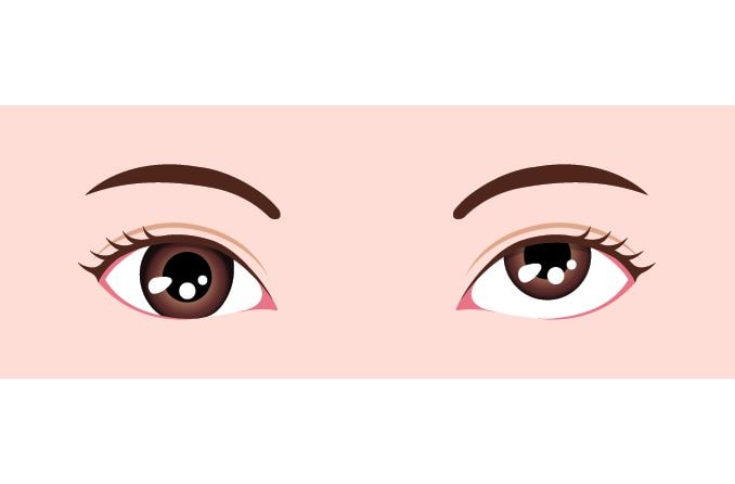 illustration of hypertopia (type of strabismus)