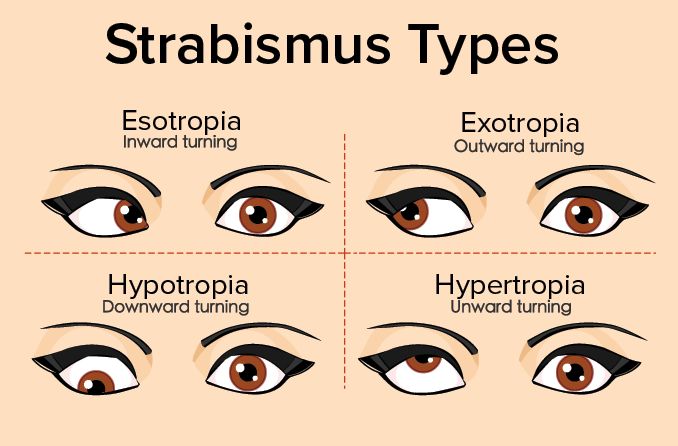 illustration of the different types of strabismus