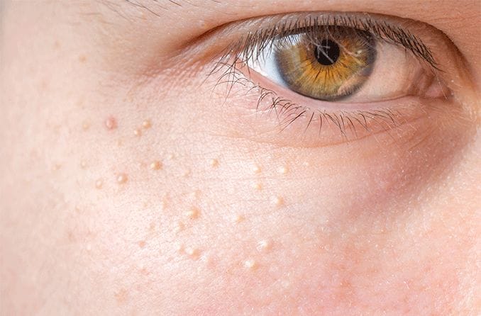 closeup under eye with syringoma