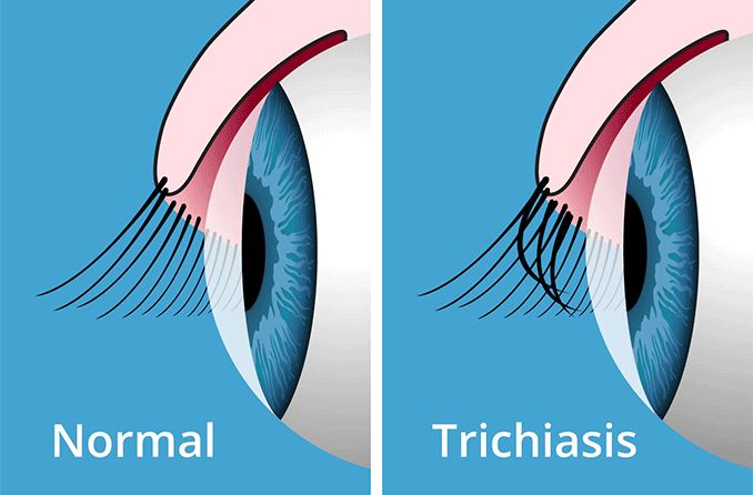 illustration sideview of a normal eye vs an eye with trichiasis