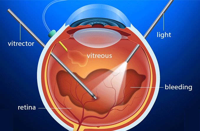 vitreoretinal procedure after vitreous hemorrhage