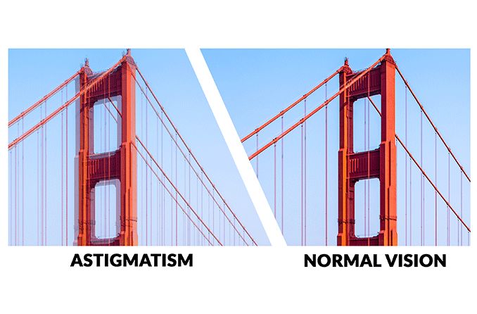 Astigmatism Articles On Causes Symptoms Corrective Lenses