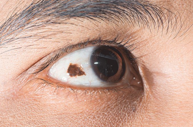 closeup of an eye with a conjunctival nevus