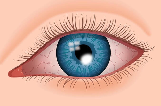 Illustration of eye with corneal ulcer