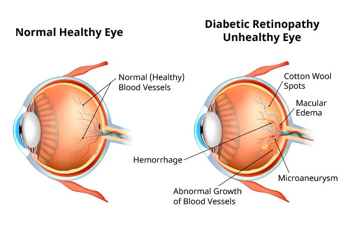 Diabetic retinopathy