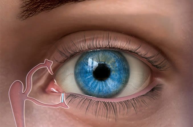 illustration of punctal plug in an eye