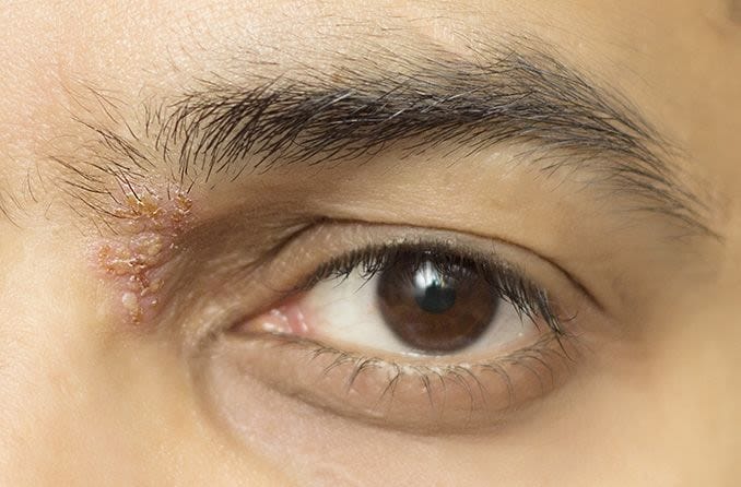 Closeup of a man with eye shingles