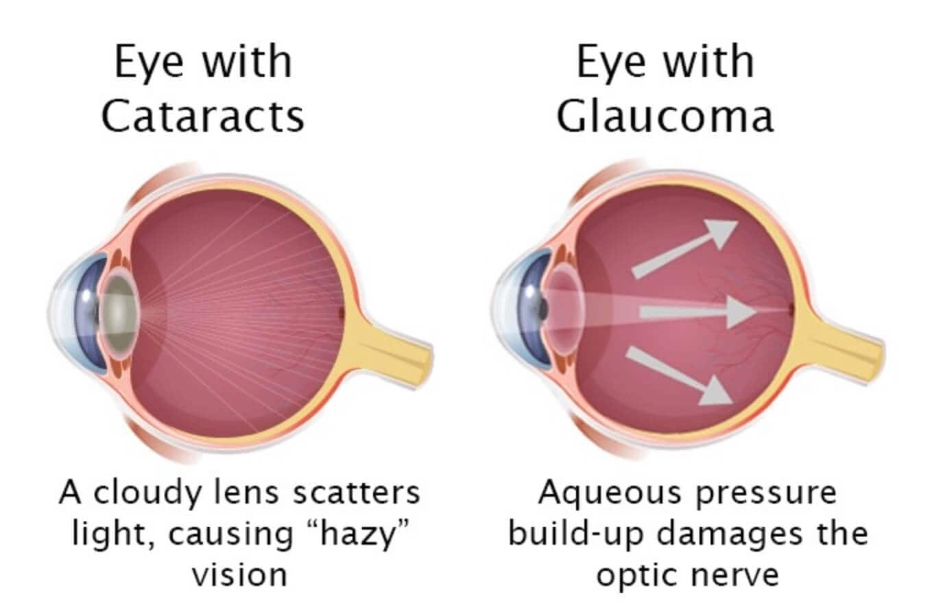 Depiction of a cataract v glaucoma