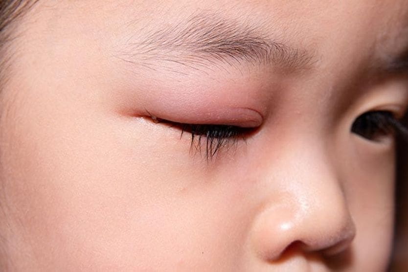 Người phụ nữ có mí mắt đỏ Người phụ nữ có mí mắt đỏ