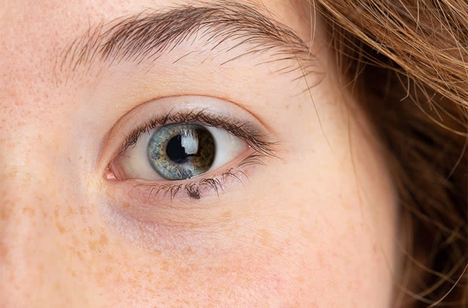 closeup of a woman's eye with partial or sectoral heterochromia