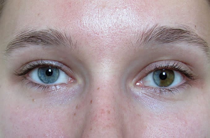 closeup of sectoral or segmental heterochromia eyes