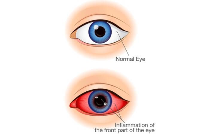 Comparison between eyes that have the symptoms of anterior uveitis and normal eyes.