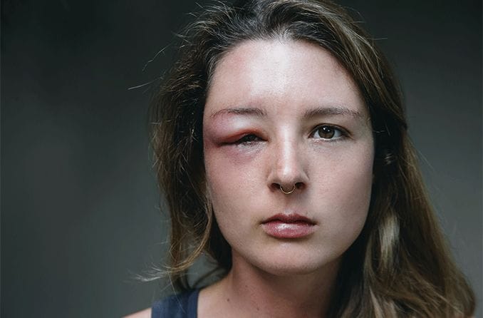 woman with orbital cellulitis