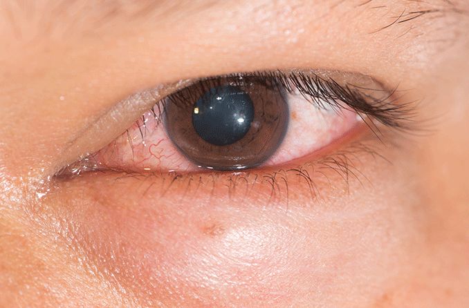 closeup of chemosis of the eye